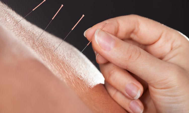 Riesgos de la Acupuntura: Mitos, Realidades y Recomendaciones